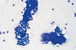 Cytologic features of various types of breast lesions as seen in FNA specimens