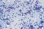 Cytologic features of various types of breast lesions as seen in FNA specimens