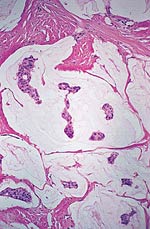 El carcinoma mucinoso de la mama.