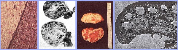 Polycystic ovary with a thickened capsule and prominent subcapsular cysts. Note lack of lutea or corpora albicantia due to anovulation.