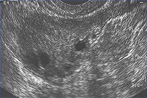 This image shows ovarian follicles in a woman with regular ovulatory cycles