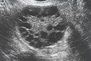 多个小卵泡显示在这里与多囊卵巢综合征的女人。
