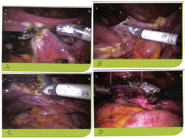 Robot-assisted hystrectomie pour des affections bnignes; A. Skeletonizing pdicules vasculaires et de coagulation; B. vsico-utrine rflexion; C. colpotomie; D. vaginale fermeture.