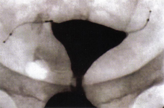 输卵管阻塞是确定在12周以下Essure （胎体公司，加州Mountain View）microinsert由输卵管的位置。