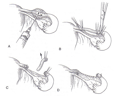 The Uchida procedure for sterilization