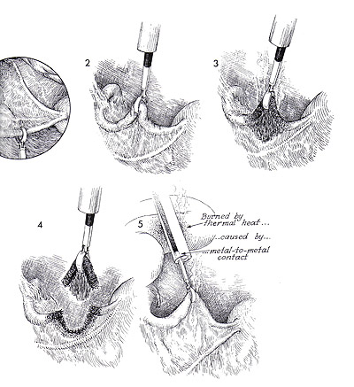 La strilisation par lectrocoagulation et la division par laparoscopie