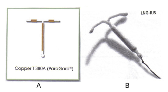 Dos tipos de dispositivos anticonceptivos intrauterinos estn disponibles en los Estados Unidos. A: TCu380A, ParaGard , B: sistema intrauterino liberador de levonorgestrel (LNG-IUS), Mirena 