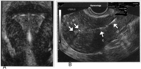 Imaging of intrauterine contraceptive devices with transvaginal ultrasound. A: 3-D image of appropriate fundal position of IUD; B: With this sagittal view, the superior component of the device (a) is imaged in proximity to the fundal portion of the endometrium, (b) confirming appropriate fundal position of the IUD. The inferior component of the device (c) is imaged in the lower uterine segment, and the threads (d) are imaged in the upper portion of the endocervical canal.
