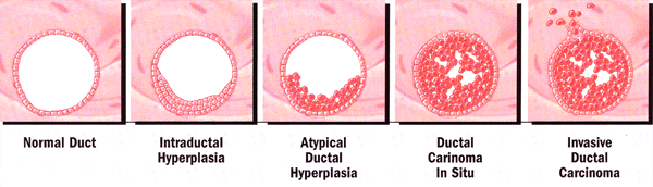 Development of ductal hyperplasia to invasive disease