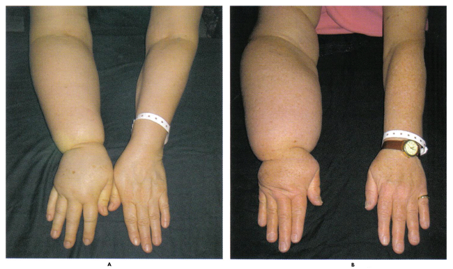 Fig. 2. Une forme potentiellement irrversible de dfiguration, le lymphoedme peut entraver la fonction du bras et est souvent diagnostiqu trop tard pour que le traitement soit efficace. Les femmes ont connu des augmentations photo ci-dessus du volume du bras de 31% (A) et 54% (B).