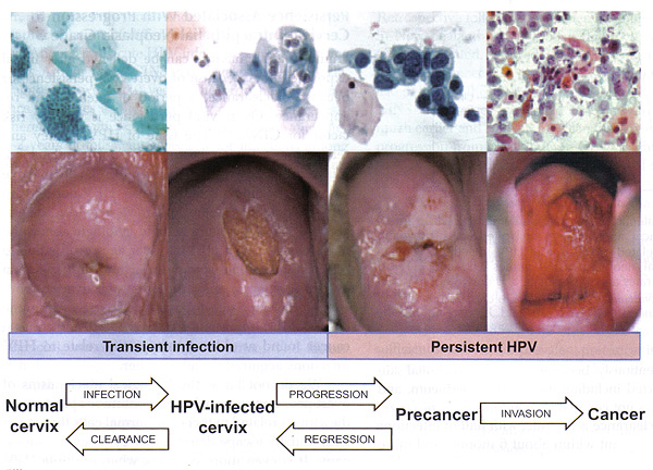 Figure 1. Cervical cancer progression model.