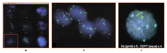 Figure 1: A. Digitalized cell information and data for 3q gain, specimen: <i>onco</i>FISH cervical; B. Cell are detected using both reflected and transmitted light microcopy; C. Positive for 3q gain (>2 nuclei with gain of >copies of 3q). Photographs courtesy of Ikonisys Inc.
