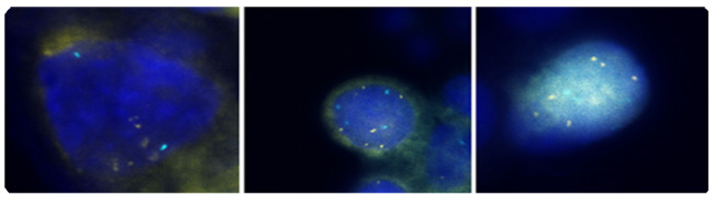 Figura 2: 3q fluorescencia de hibridacin in situ (FISH) las seales son de color oro y el control centromrica 7 seales FISH, son de color <i>aguamarina.</i> Todas las tres clulas presentan ms de 4 3q <i>(oro)</i> seales de FISH. Fotografas cortesa de Ikonisys Inc.