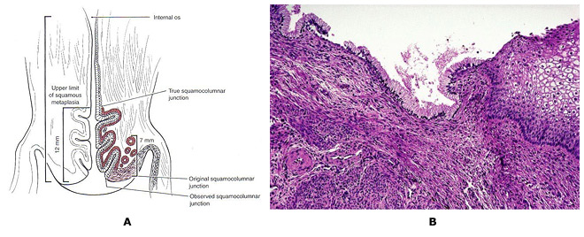 Figure 4: A. The Anatomy of the transformation zone; B. Transformation zone (TZ) in uterine cervix between exocervical squamous cells and endocervical mucin-producing glandular epithelium.