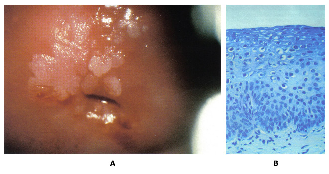 Figure 5: A. Colposcopic photograph of the cervix after the application of the acetic acid demonstrating numerous acetowhite lesions consistent with a low-grade squamous intraepithelial lesion (LSIL). B. Histologic findings show loss of polarity in the lower third of the epithelium and numerous koilocytes, consistent with cervical intraepithelial neoplasia, grade 1, with HPV features.