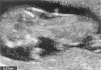 在12周增加，在患有唐氏综合征胎儿的三点七毫米测量胎儿颈项透明