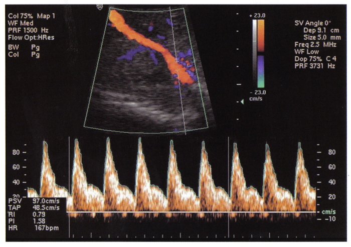 Fig. 2. La visualisation de l'aorte thoracique et sa forme d'onde la vitesse d'coulement. l'indice de pulsatilit: 1,58 indique un flux sanguin normal 