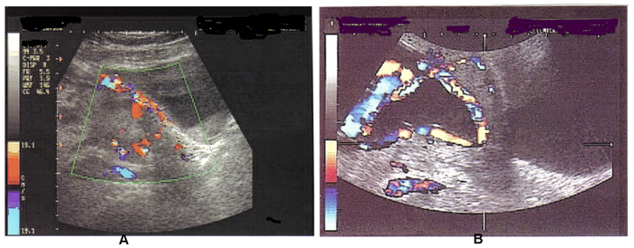 Fig. 3 A. ecografa Doppler color de acretismo placentario; B. Color de la ecografa Doppler de vasa previa