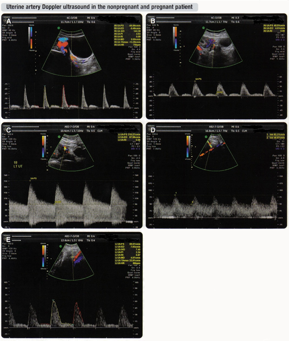 Fig. 4 A. paciente no embarazadas; B. Primer trimestre; C. en el segundo trimestre; D. Tercer trimestre; E. anormal de la arteria uterina Doppler de demostrar una alta resistencia.