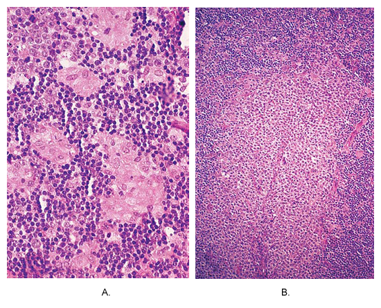 Toxoplasmosis of lymph node. (A) Small non-caseating granulomas composed of epithelioid cells are located at the periphery of hyperplastic follicle. This picture is almost pathognomonic of this disease. (B) An area of massive monocytoid B-cell hyperplasia.