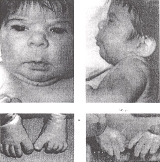 胎儿乙内酰脲综合征：面部特征-姿态鼻子，轻度中部发育不全，长薄上唇唇红边界并降低远端数字发育不全。