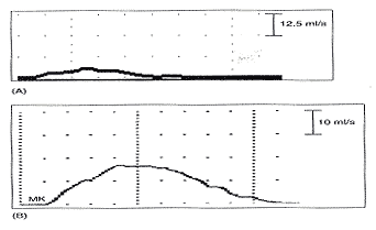 Effect on uroflow of 7F urodynamic catheter. There are three potential sources of error in the uroflow obtained with the 7F urodynamic catheter in place. Firstly, the patient had a strong urge to void and voided with only 104 ml in her bladder, too low volume for accurate assessment. Secondly, the catheter itself may cause obstruction, and finally, the patient may not sufficiently relax in the setting of the urodynamic examination. (A) Uroflow obtained with 7F urodynamic catheter in place. VOID = 6/78/26. (B) Uroflow obtained prior to urodynamic study without a urethral catheter in place VOID = 16/190/5