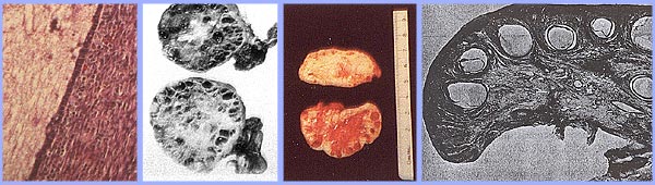 polycystic овариальный синдром