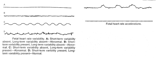 Normal vs. Abnormal Fetal Heart Rate