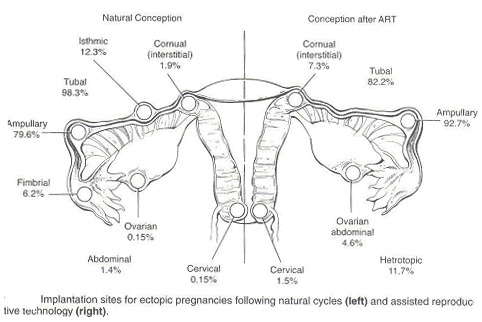 Ectopic Pregnancy on Women S Health And Education Center   Obstetrics   Ectopic Pregnancy