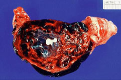 破裂的输卵管妊娠有明显出血。  微小的胚胎是可识别的，在中心的血块。  