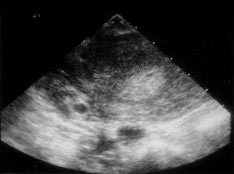  An ultrasound image showing an empty endometrial cavity and a 5 mm gestational sac in the right adnexa.