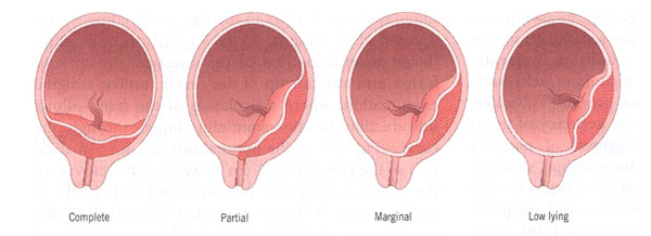 Tipos de previa de la placenta.