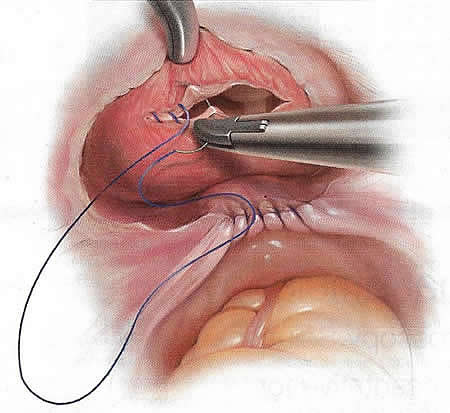 Double-layered closure of a cystotomy.