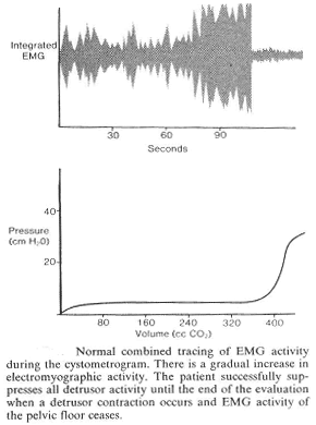 Normal combined tracing of EMG activity during the cystometrogram. There is a gradual increase in electromyographic activity. The patient successfully suppresses all detrusor activity until the end of the evaluation when a detrusor contraction occurs and EMG activity of the pelvic floor ceases.