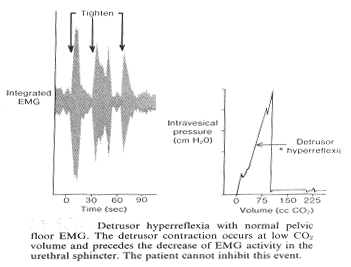 Detrusor Гиперрефлексия с нормальной тазовой этаж ГРП. Detrusor сжатие происходит при низкой громкости и СО2 предшествует снижение ГРП энергии в urethral sphincter. Пациент не может помешать этому событию.