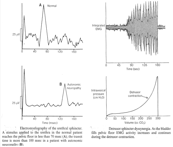 Electro myelography of the urethral sphincter. A stimulus applied to the urethra in the normal patient reaches the pelvic floor in less than 70msec (A); the transit time is more than 100msec in a patient with autonomic neuropathy. (B)  Detrusor sphincter dyssynergia. As the bladder fills pelvic floor EMG activity increases and continues during the detrusor contraction. (at right)